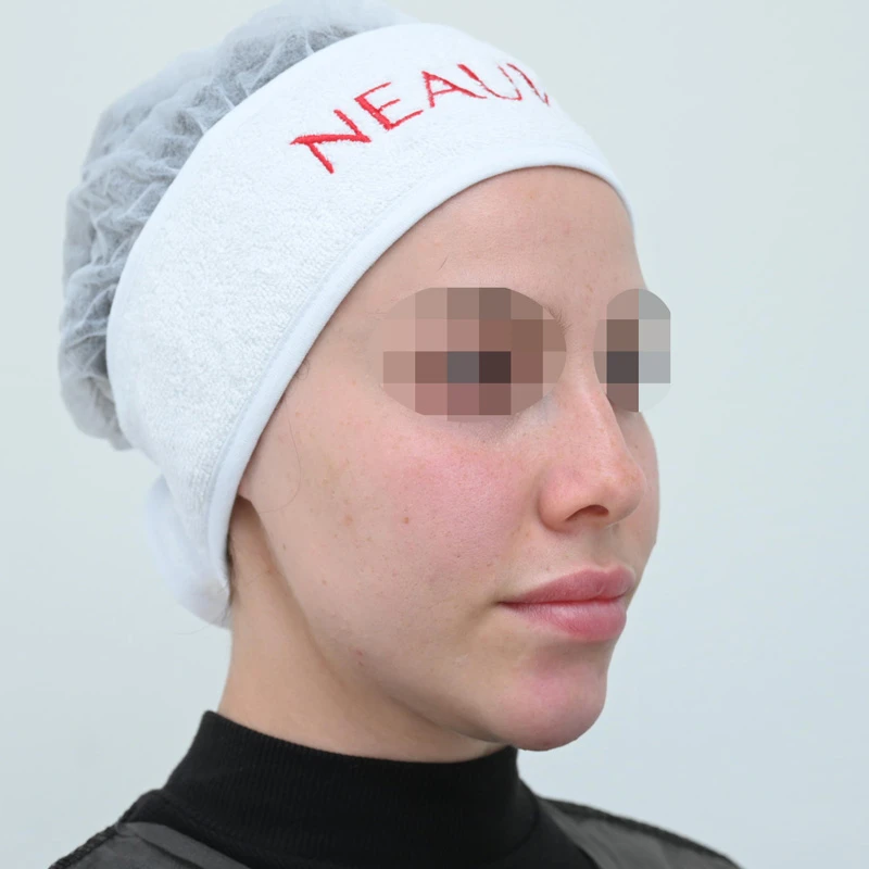 Процедура Fresh&Lift, фото до