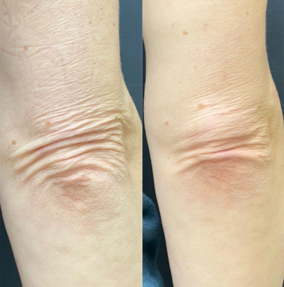 Sculptra. Клинический случай
