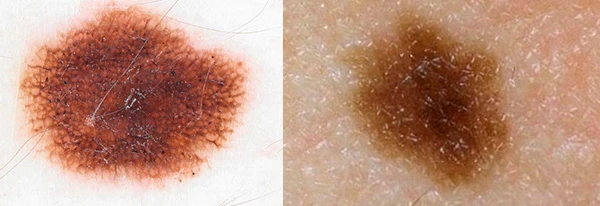 Дерматоскопия