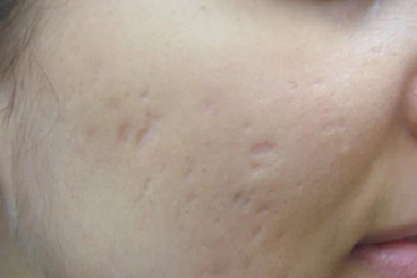 Harmony XL Pro, фото до