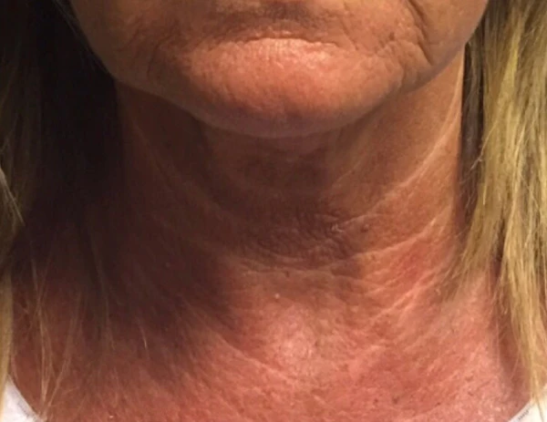 Омоложение шеи. Возраст > 40 лет