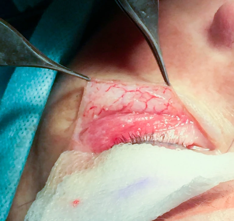 отделенный однослойный кожный лоскут