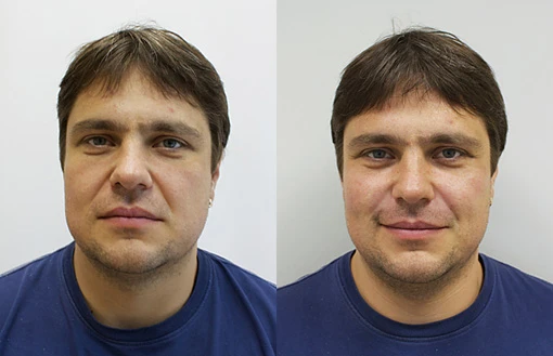 подтяжка лица +до +и после