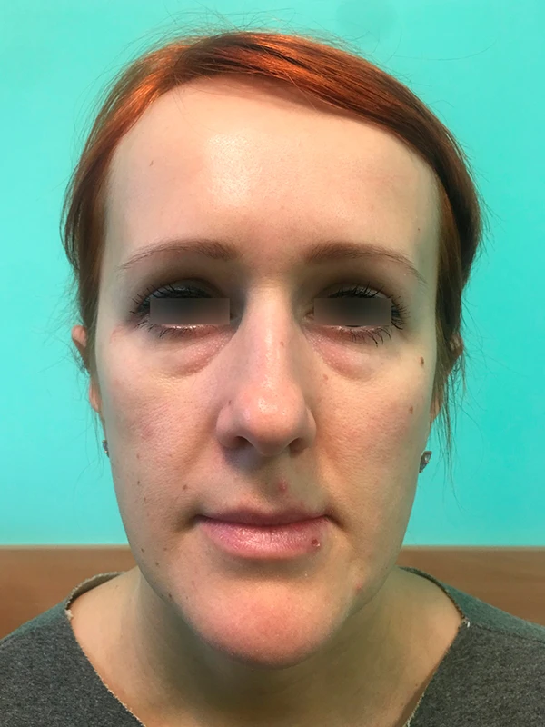 Трансконъюнктивальная билатеральная блефаропластика: фото до