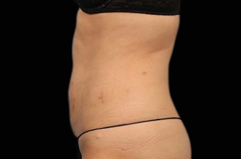 Фото после 4 процедур на аппарате EMSCULPT