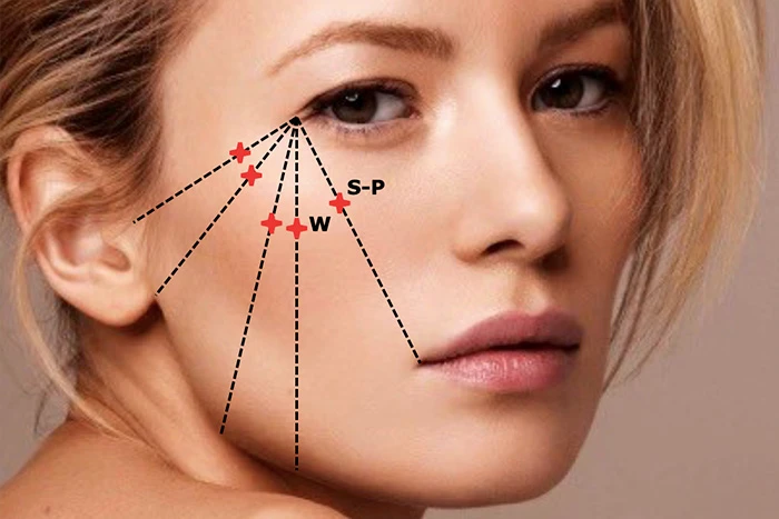 скуловая область, разметка, Restylane Perlane