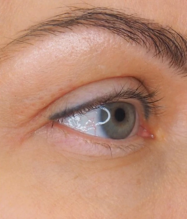 Блефаропластика на аппарате Plasmage. Фото после