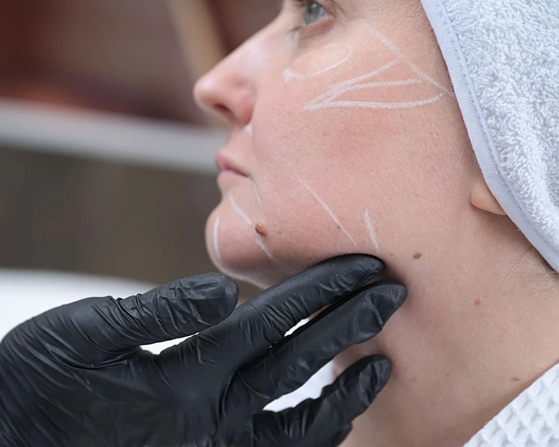 Neauvia Разметка