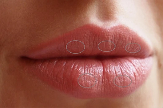 Бугорки на губах