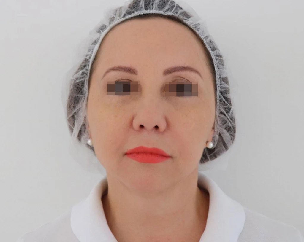 Сочетанное применение Ultherapy и филлерной коррекции