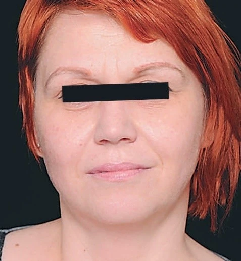 Hyalual После процедуры