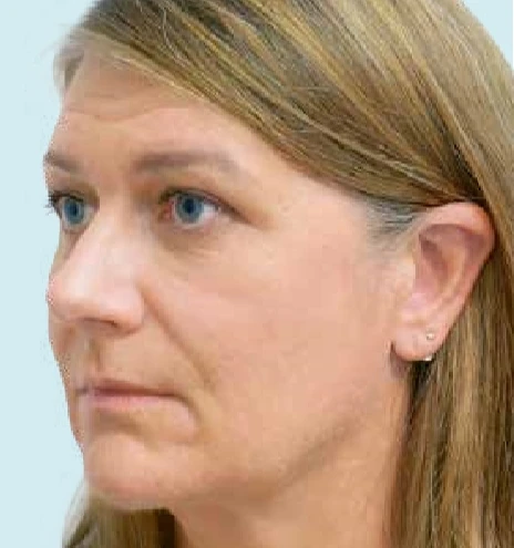 Качество кожи до применения филлера Radiesse®