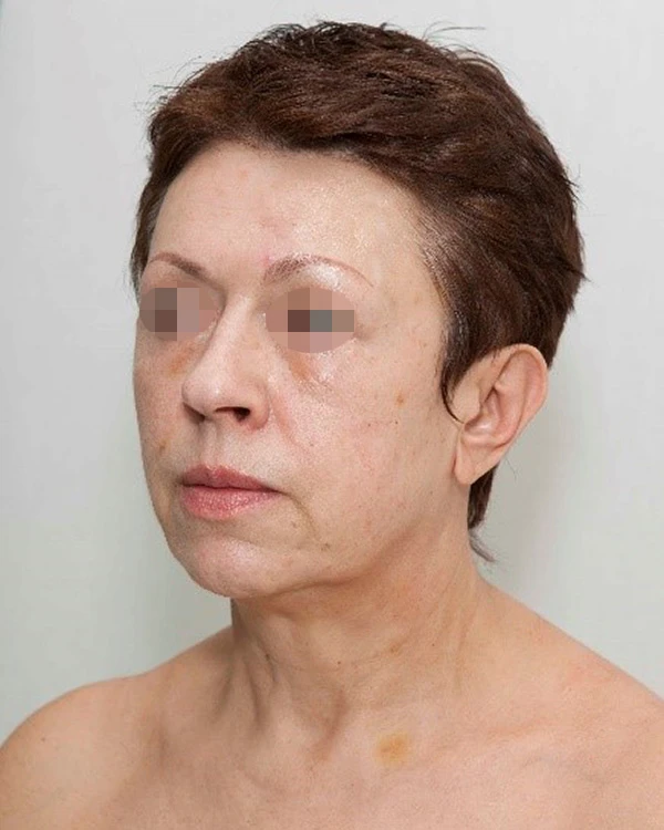 Аминокислотно-заместительная терапия препаратом Jalupro®