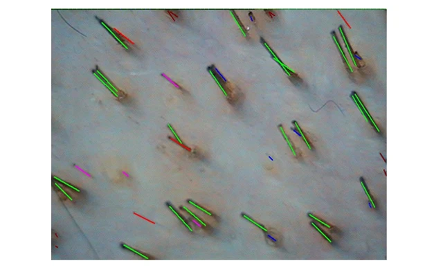 Теменная область на фототрихограмма при диффузном выпадении волос 