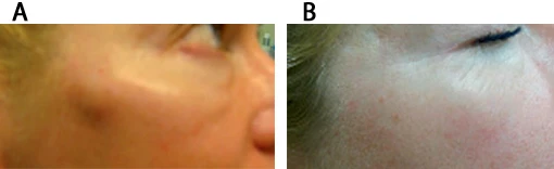 Препараты гиалуронидазы