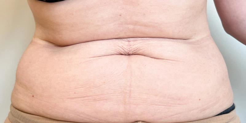 Комбинированный протокол Ulfit + Volnewmer, фото после