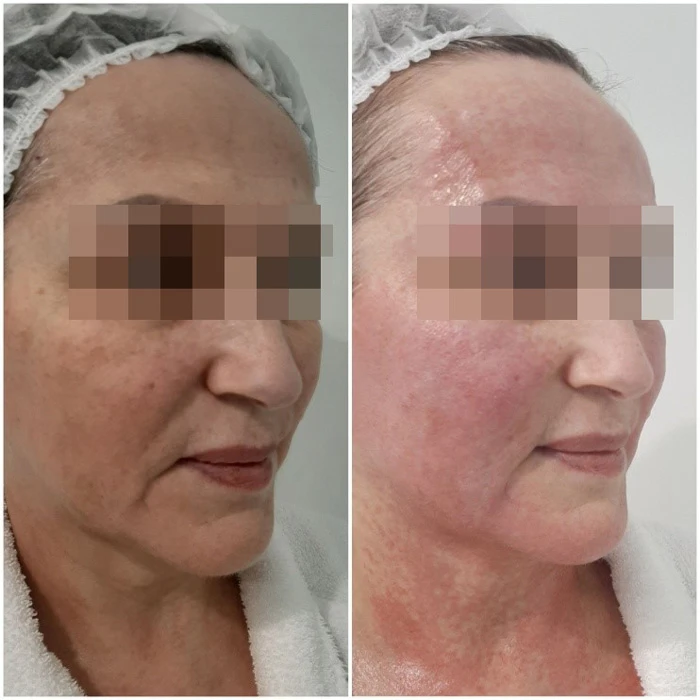 Hyalual 2,2 % и Perfoskin Complex. Фото до и после