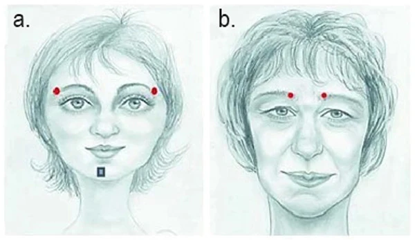 точки инъекций в каудальные участки бровей и в область головок бровей