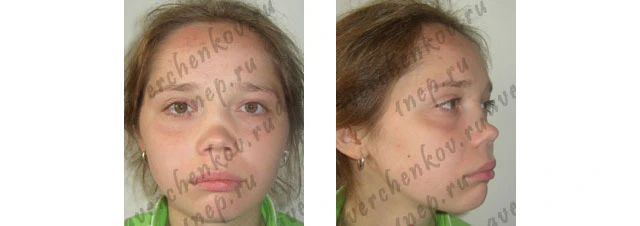 Пациентка до операции в фас и в профиль