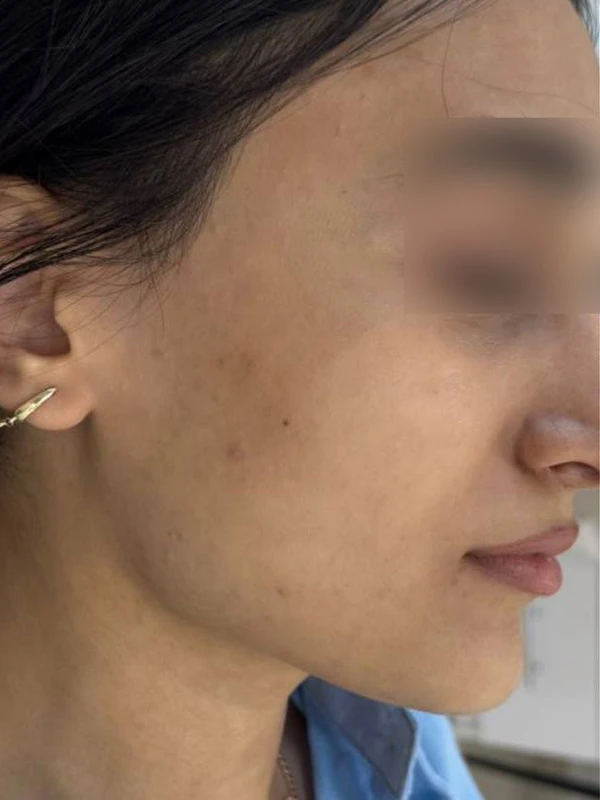 Лазерное лечение гиперпигментации: фото после