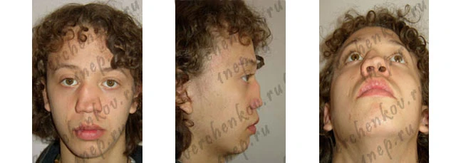 западение спинки носа хрящевого отдела