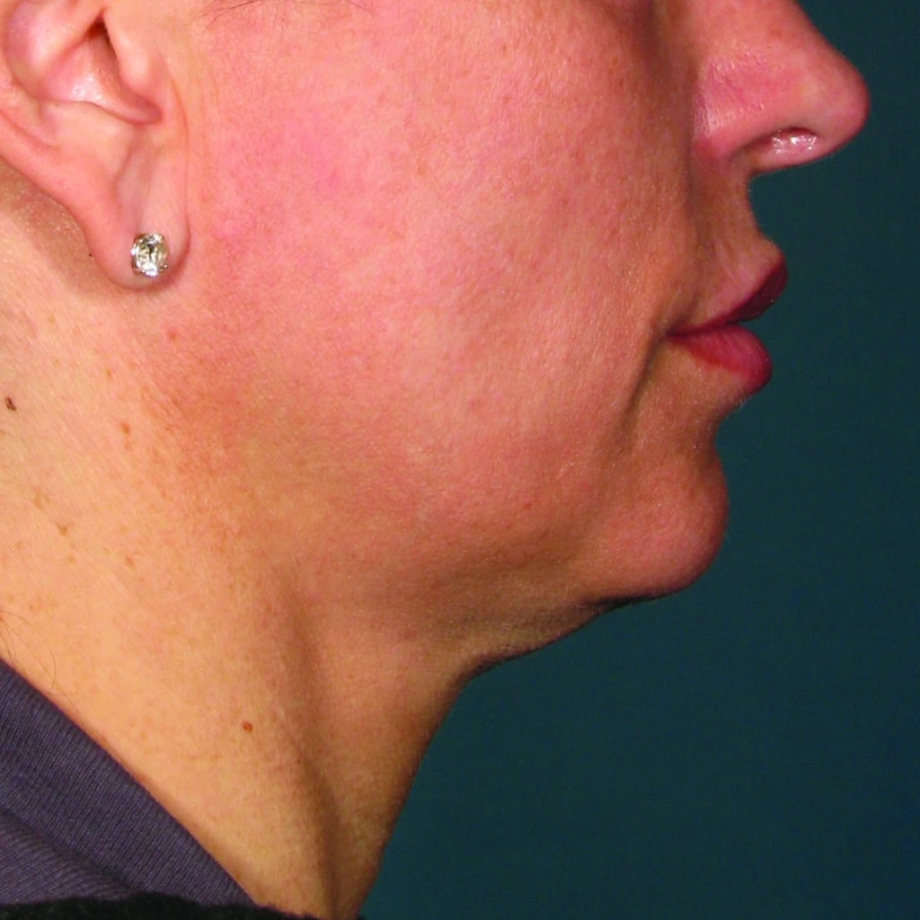 Ultherapy До