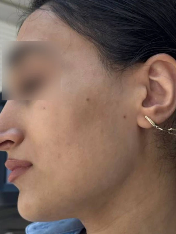 Лазерное лечение гиперпигментации: фото после