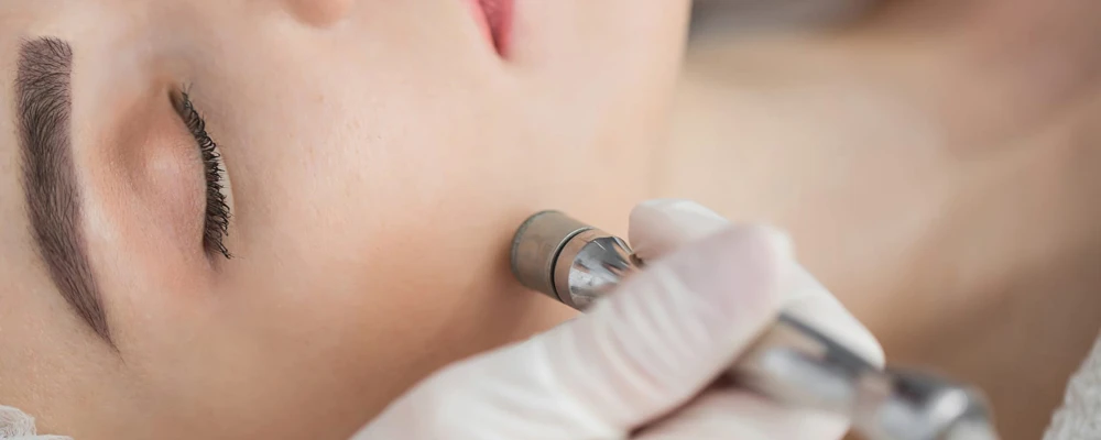 Микродермабразия