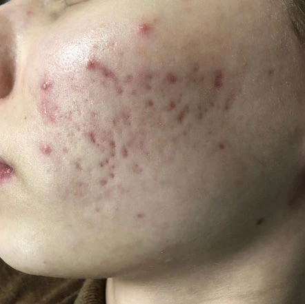 BBL BroadBand Light Acne