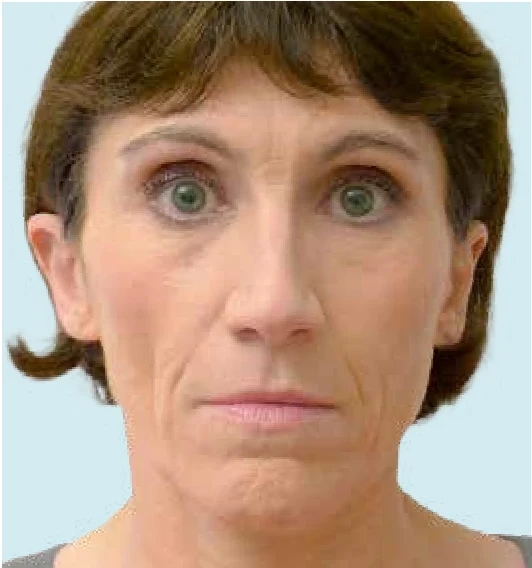 Качество кожи до применения филлера Radiesse®