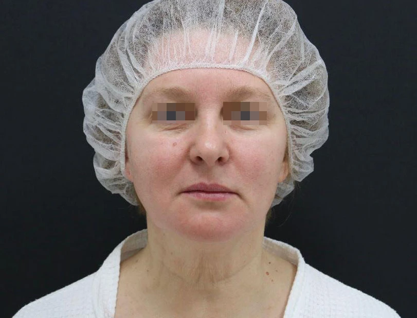 Сочетанное применение Ultherapy и филлерной коррекции