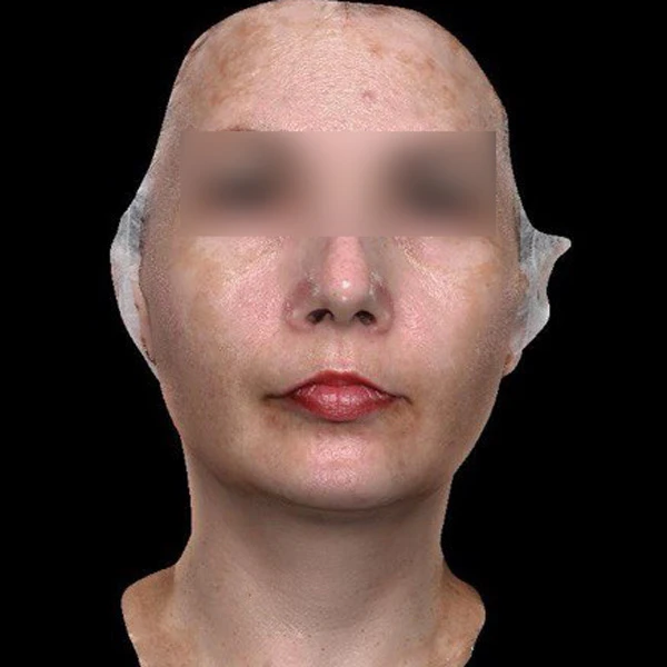 Лазерное лечение гиперпигментации: фото до