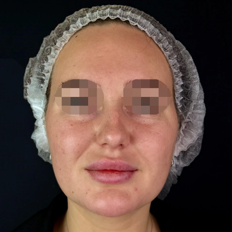 ClearLight IPL