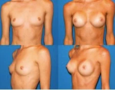 Пример груди класса 4