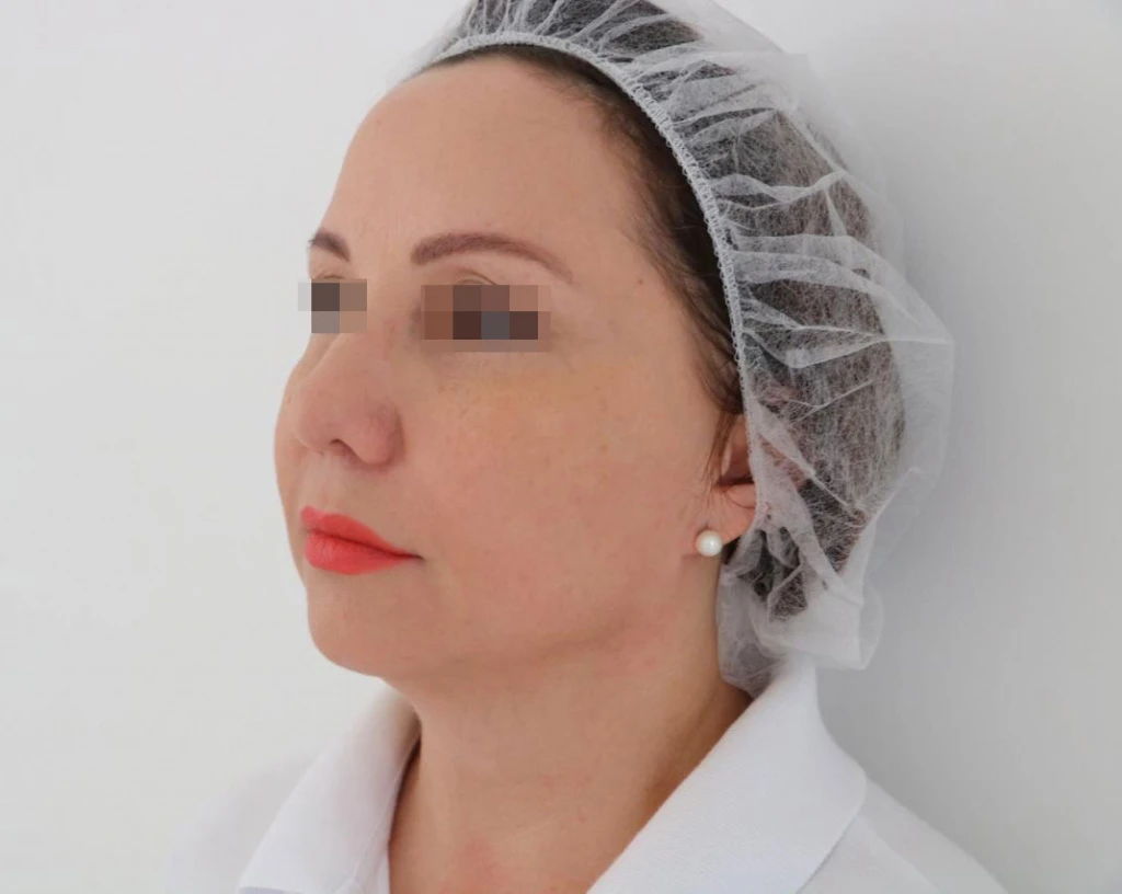 Сочетанное применение Ultherapy и филлерной коррекции