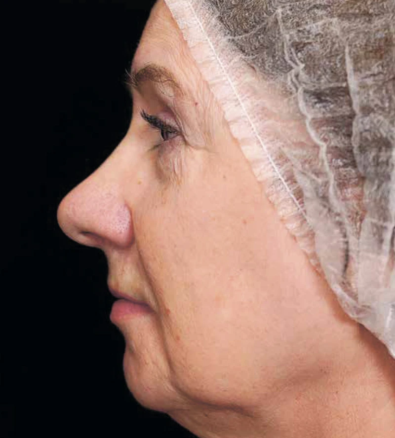 Bioregen + CO₂-лазер