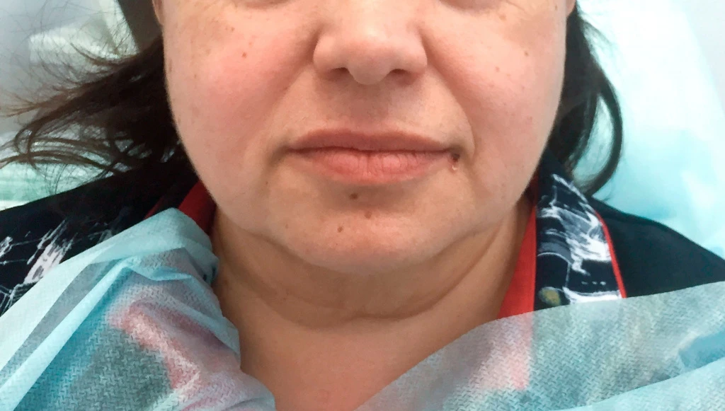 Применение Ultherapy