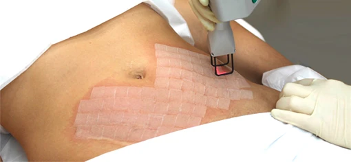 Лечение стрий