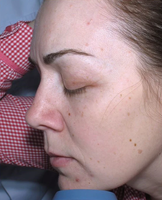 Фото после проведения процедуры HELEO4