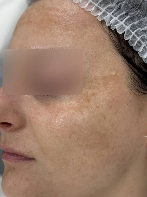 Лазерное лечение гиперпигментации: фото до