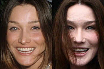 211664-carla-bruni-and-botox.jpg