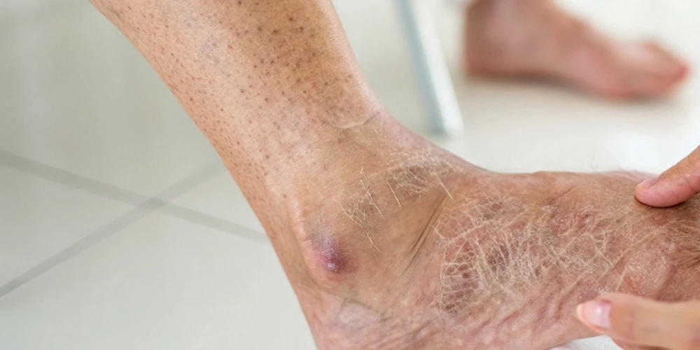 Влияние метаболического синдрома на качество кожи