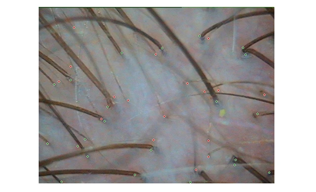 Теменная зона при андрогенетической алопеции