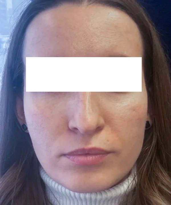 Alma Hybrid, фото после