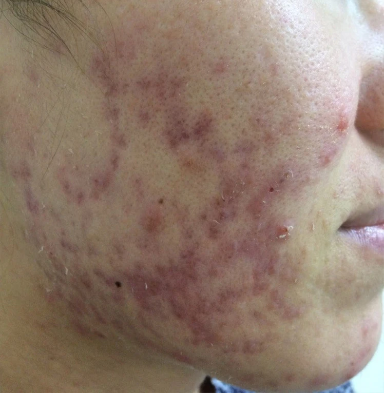 Пилинги Hyalual Peel фото до