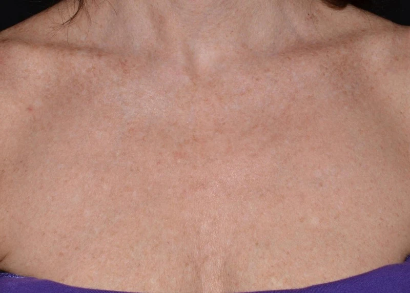 LaseMD Ultra // После процедуры