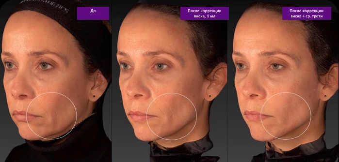 Техника В.UP филлерами Belotero, фото до и после
