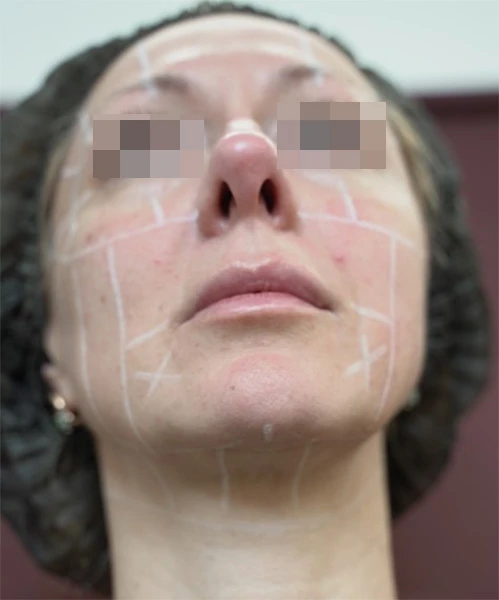 Диагностическая визуализация субментальной зоны