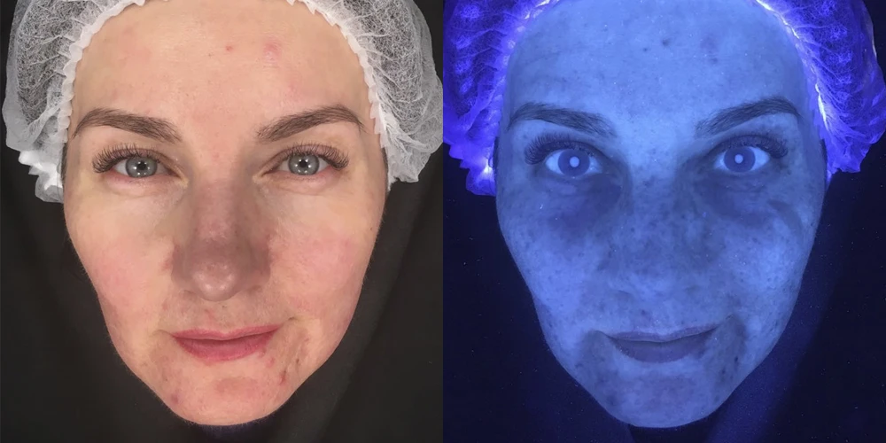 Acne vulgaris, папуло-пустулезная форма умеренной степени тяжести