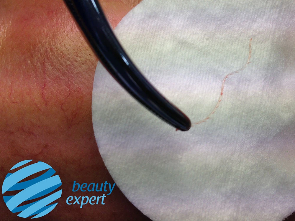 Извлеченная нить